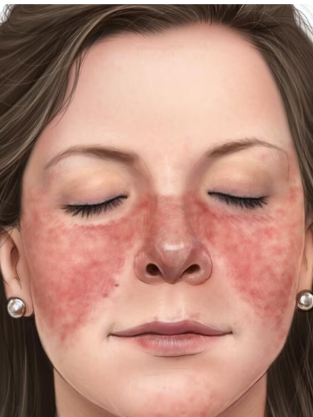 10 Surprising Insights on Lupus Nephritis and Chronic Kidney Disease Progression